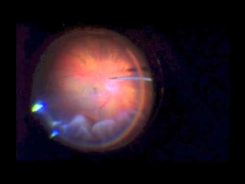 Retinal Detachment Repair With Vitrectomy