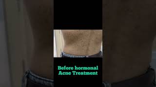 Back Acne Treatment | Acne spots | hormonal acne |Dermatologist in Punjab #drashimagoel #shorts