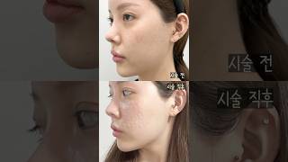 10초 만에 리쥬란 효과 체험하기👀