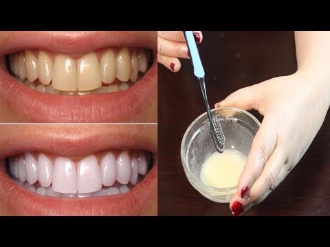 How To Whiten Teeth - Best Teeth Whitening Method - Teeth Whitening At Home Video