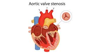 Symptoms, Risks and Treatment Options for Aortic Valve Stenosis