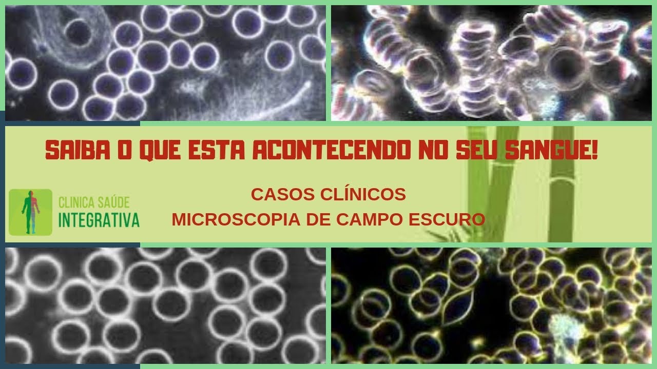 Casos Clínicos - ESTUDO DO SANGUE VIVO. (Microscopia de Campo Escuro)