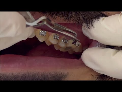 How to fix the bracket on the ceramic crown? bond #braces on ceramic or composite restoration