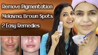 Remove Pigmentation, Melasma, Freckles, Brown Spots / Results In One Week - Ghazal Siddique