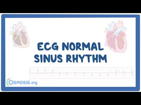 Nhịp xoang bình thường trên điện tâm đồ (ECG normal sinus rhythm)