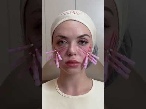 Ruby No.5 thread lift — collagen stimulation, immediate tightening