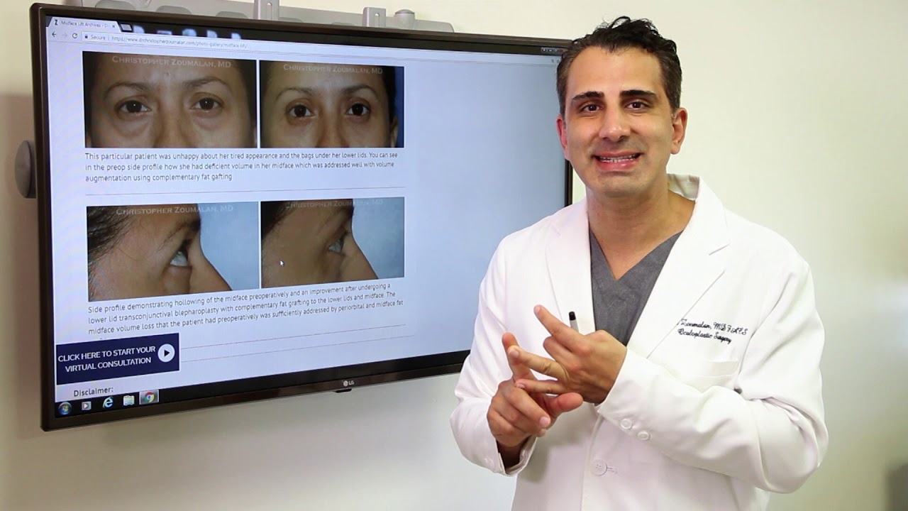 Midface Lifting Beverly Hills