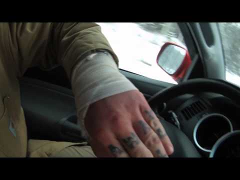 Ryan's Wrist Surgery and Recovery Time