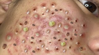 Loan Nguyen Acne Treatment 6m