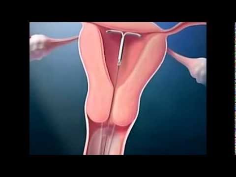 Esercizi per unernia spinale nella zona lombare e cervicale Curcuma è benefico per giunti