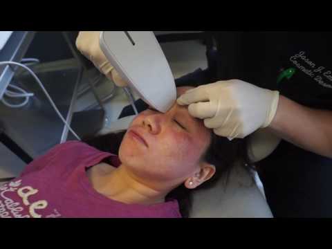 Venus Viva for Acne Scar Treatment | Wrinkle Treatment | Skin Re-surfacing | Dr. Jason Emer