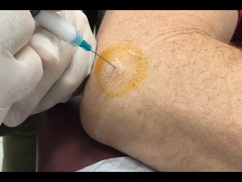 Thorakale Gefäße Ursachen von Gelenkerkrankungen