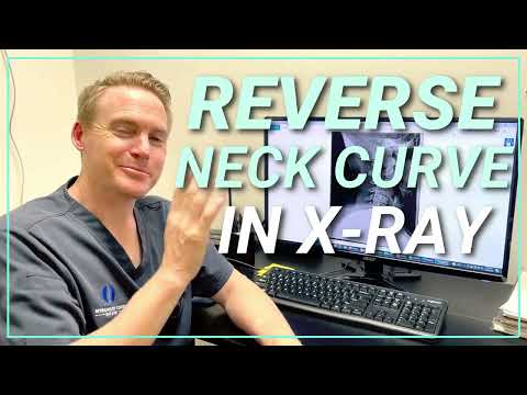 Reverse Neck Curve: Causes, Effects, and Solutions | Spine & Injury Medical Center | San Jose, CA