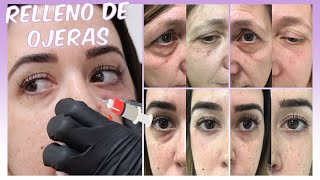 DESPIDETE DE TUS OJERAS | RELLENO CON AC. HIALURÓNICO