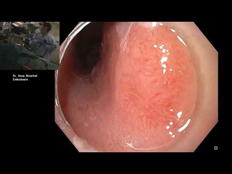 02/07 Endosummer 2019 – Live Endoskopie Teil 1