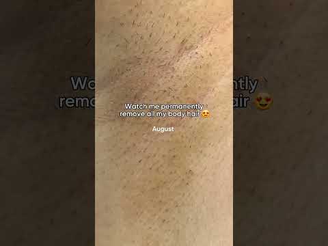 12 months of using Lumi IPL Hair removal  #hairremoval #laserhairremoval #hairremovalmethods