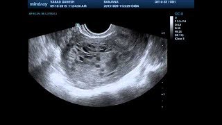 early pregnancy bleeding:" abortion , ectopic pregnancy"