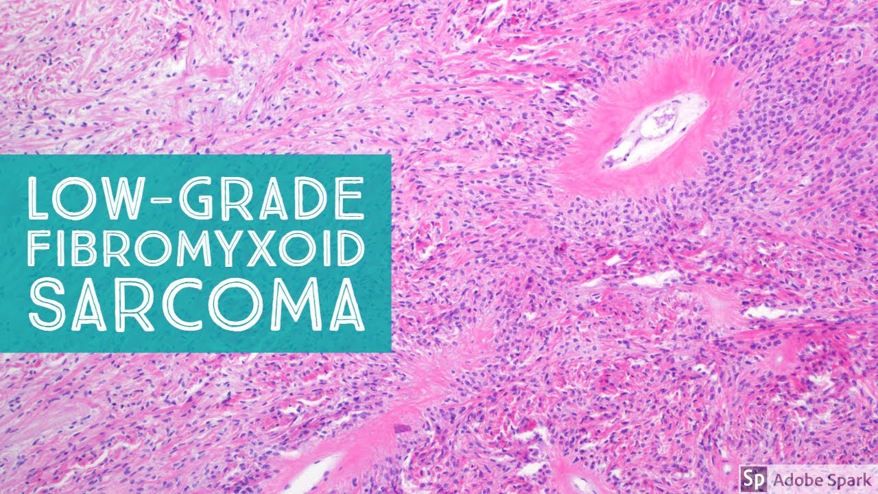 Low-Grade Fibromyxoid Sarcoma (Evans Tumor) 101...Explained by a Sarcoma Pathologist