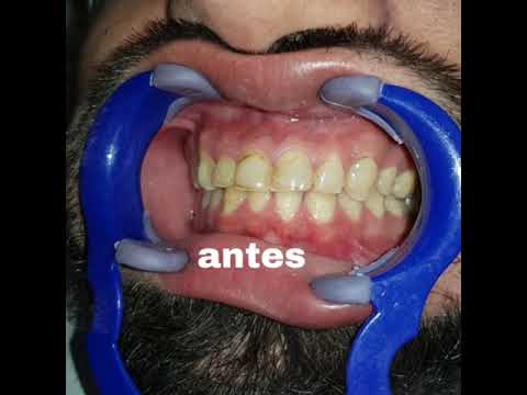 Smile Makeover in Cartagena, Colombia by dentist Tarsys Loayza Roys