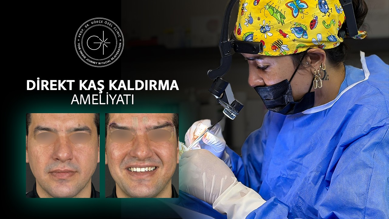 DİREKT KAŞ KALDIRMA, ÜST GÖZ KAPAĞI AMELİYATI I AMELİYAT SONRASI #browlift #gözkapağıestetiği