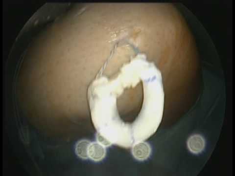 Gemeinsame Cervical-thorakale Osteochondrose Halswirbelbruch Behandlung