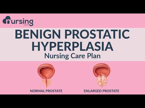 What is Benign Prostatic Hyperplasia and how to care for it as a nurse (Nursing Care Plan)