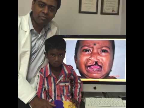 Left Complete Cleft Lip - Results After 5 Years