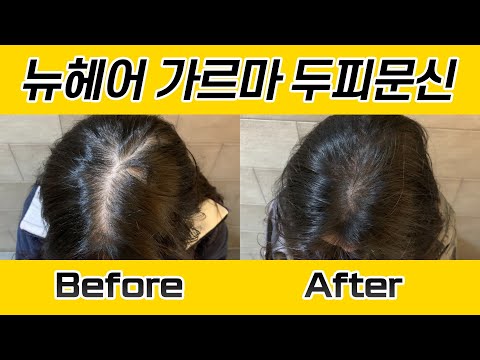 여자 가르마 두피문신 시술 전후 I 뉴헤어 SMP I 두피문신 I 탈모치료 I Before&After