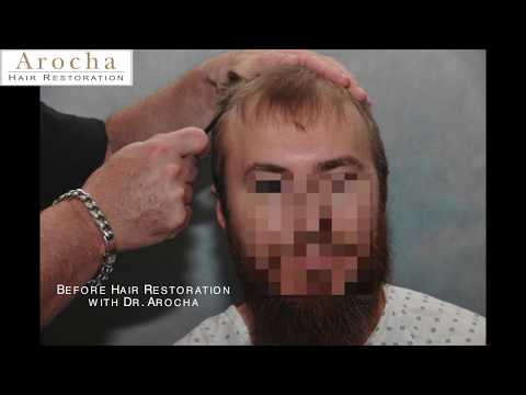Best Hair Transplant Clinic in Texas! Hair loss and...