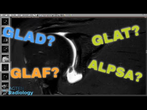 MRI of Glenoid Labral Flap Tear - A Pathognomonic Lesion (Rare)