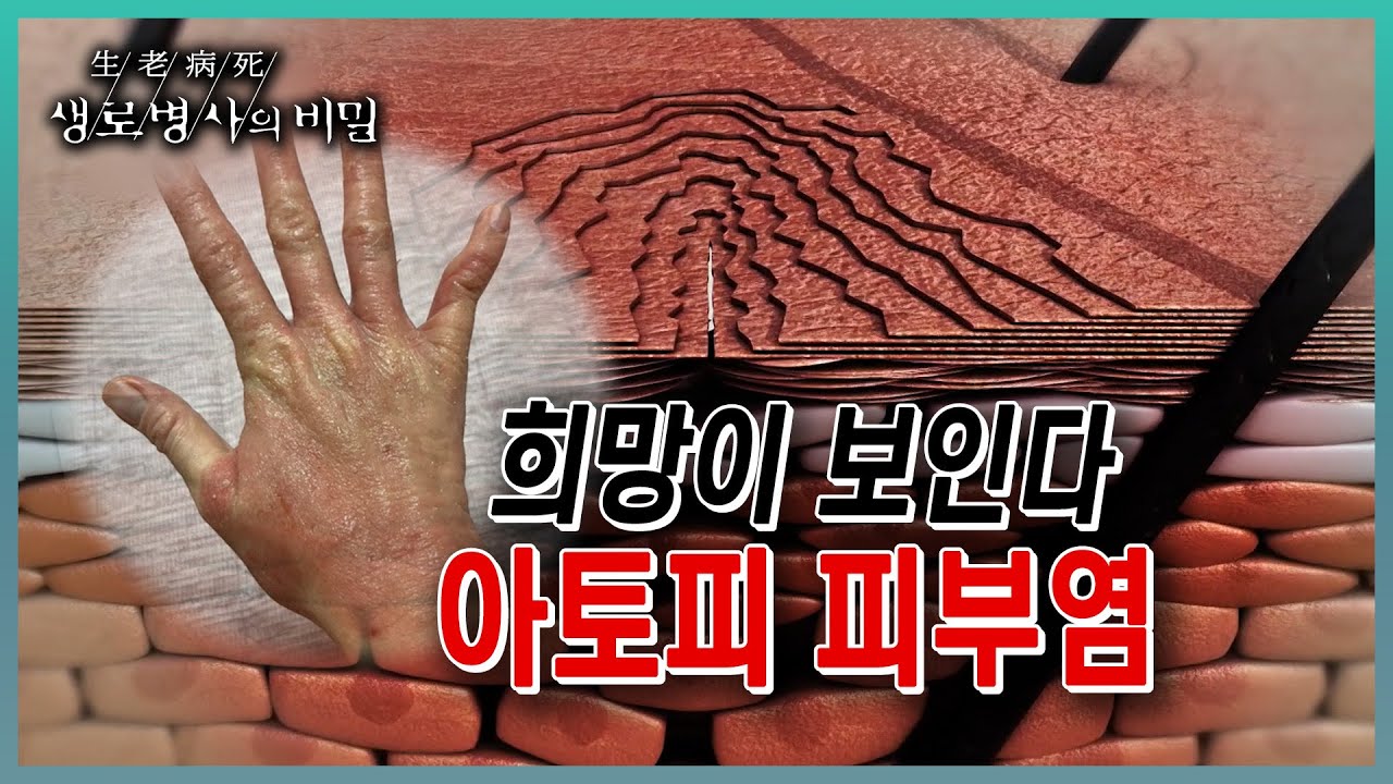 📌방송 하이라이트📌 '비정상적인 반응, 기묘한' 등의 뜻을 가진 아토피. 발병원인과 치료법이 명확하지 않은데, 아토피피부염 증상과 치료에 대한 모든것(KBS 20230628 방송)