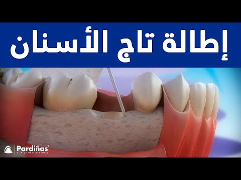 إطالة تاج الأسنان ©