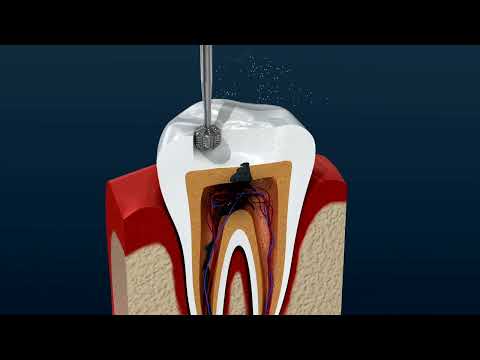 Root Canal Treatment — video thumbnail