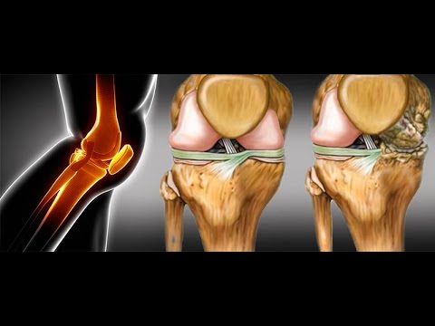 artroza articulațiilor ureaplasmozei dureri articulare cervicale și tratament