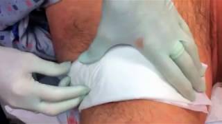 Hidradenitis Suppurativa Institute: CO2 Laser Excision and Marsupialization Surgery
