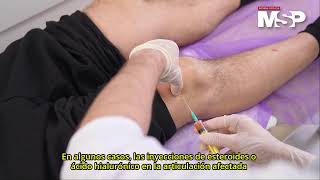 Artrosis: ¿Cómo desgasta el cartílago y afecta la movilidad?