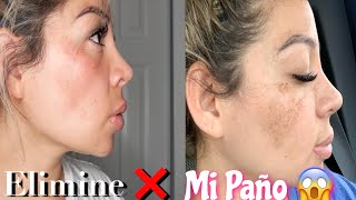 Elimine ❌ el Paño En 2 SEMANAS 😱 , Esto Es SORPRENDENTE😱