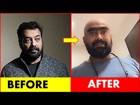 ANURAG KASHYAP’S  LOOK CHANGED AFTER ANGIOPLASTY