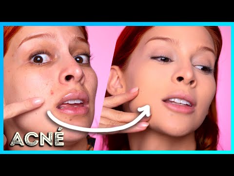 Como Ocultar ACNÉ CON MAQUILLAJE
