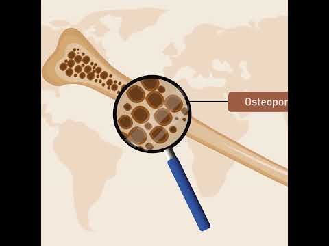 Dr MAYUKH GUHA ANKYLOSING SPONDYLISITS