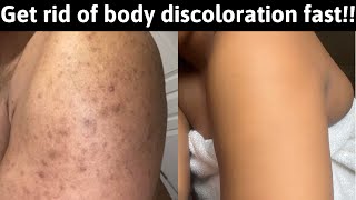 How to get RID of body DISCOLORATION FAST: the ultimate routine for HYPERPIGMENTATION