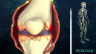 Infiltración de ácido hialurónico