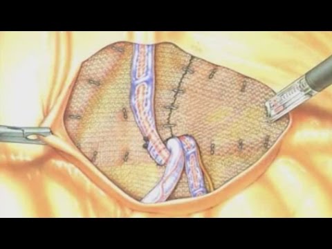 Nackenschmerzen mit Pankreatitis Wunden unteren Rücken Steißbein