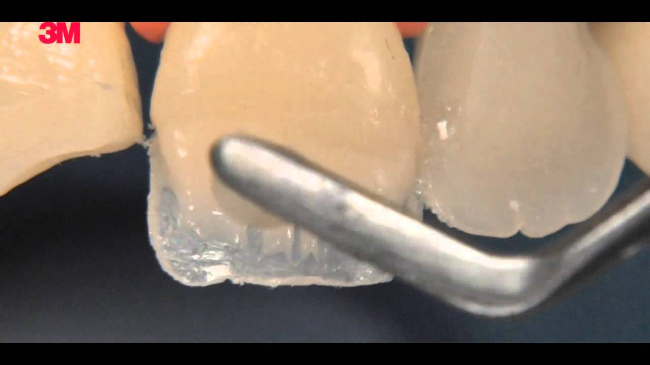 WEB VIDEOS 3M - Esquemas para restauração de dentes anteriores: como usar as diferentes opacidades.