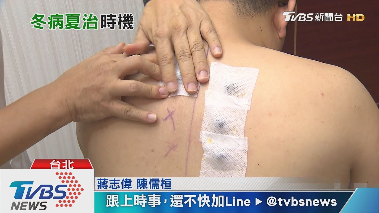 注意！罹這病冬病夏治　虛寒體質者「穴位貼敷」這款藥餅！