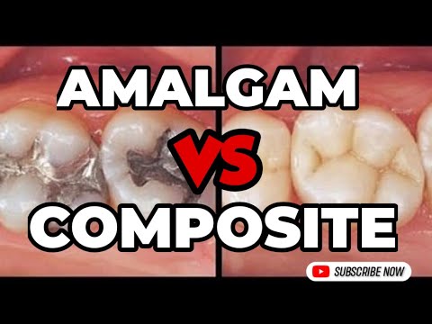 Amalgam Filling