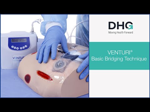 DHG Venturi Basic Bridging Technique