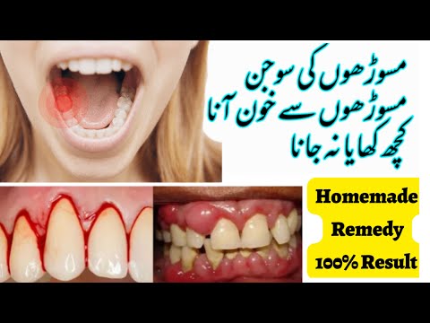 Gum Swelling Treatment | Masudo me sujan aur dard ka ilaj | Homemade Remedy | Saira Kanwal