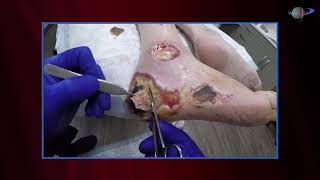 WCW: Determining When to Debride Eschars