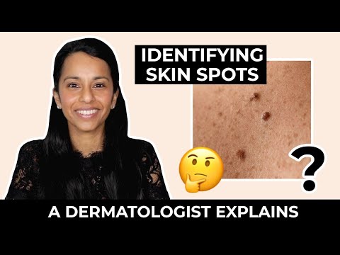 Difference Between Moles, Skin Tags, Milia, Freckles and More!